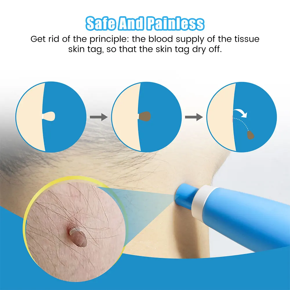 Auto Skin Tag Removal Tool Kit – Luxury Skincare Acne Bewertung und Preis